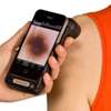 استفاده از گوشی‌های هوشمند برای تشخیص سرطان پوست